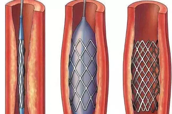 Why Are Laser Cutting Machines Used to Make Medical Components?